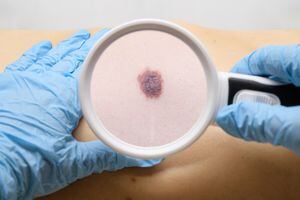 Examen del melanoma