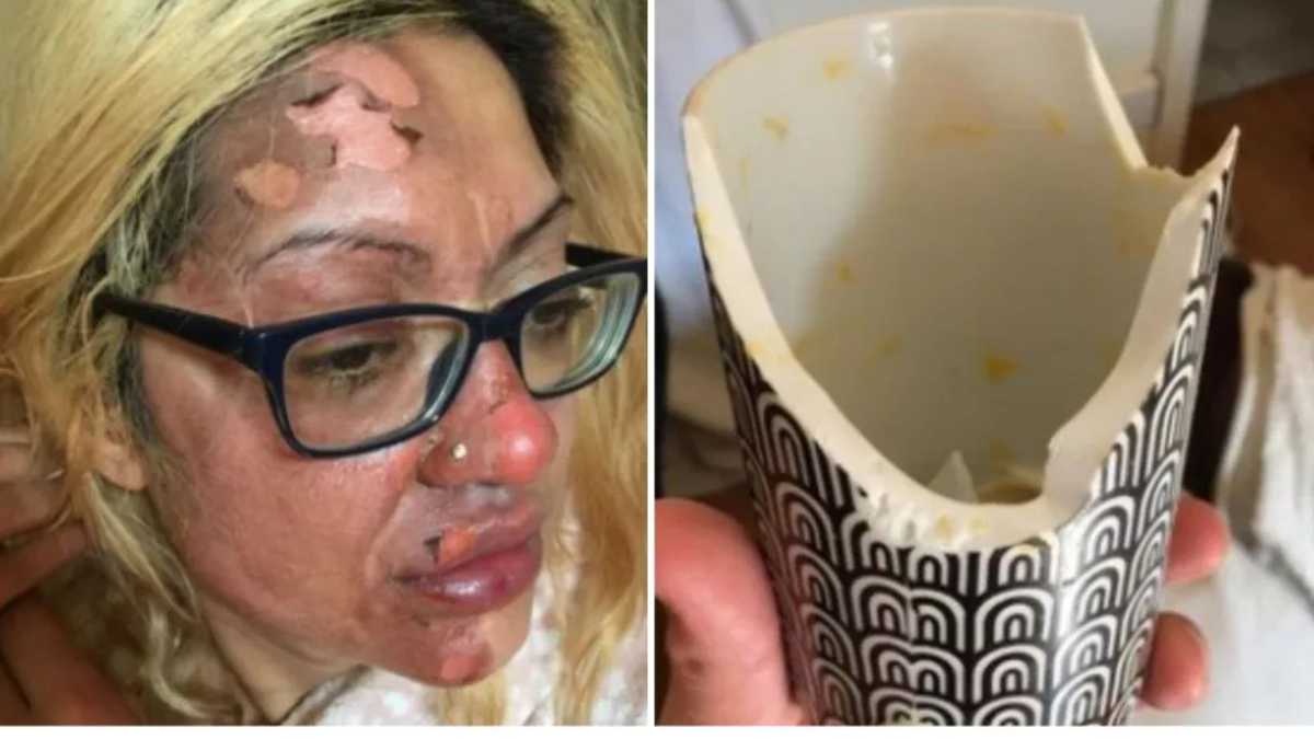 Mujer resultó quemada en el rostro por fallido truco de Tiktok para cocinar un huevo