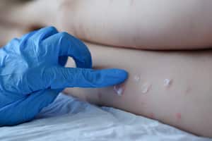 La viruela del mono es la nueva enfermedad que tiene en alerta a la OMS. Esto es lo que se sabe del virus.