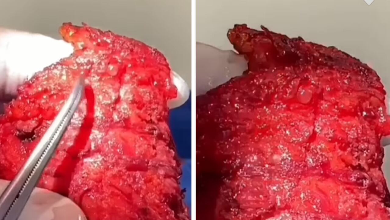 “Lágrimas de sangre”: Jessica Cediel reveló imágenes sensibles de lo que pasó con su cola por los biopolímeros