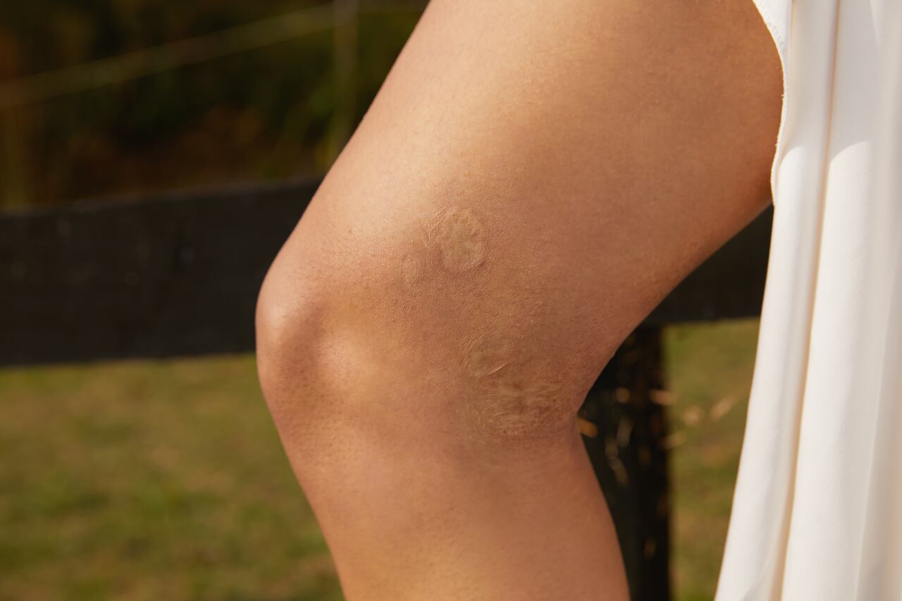 Denise Cuadrado cicatriz