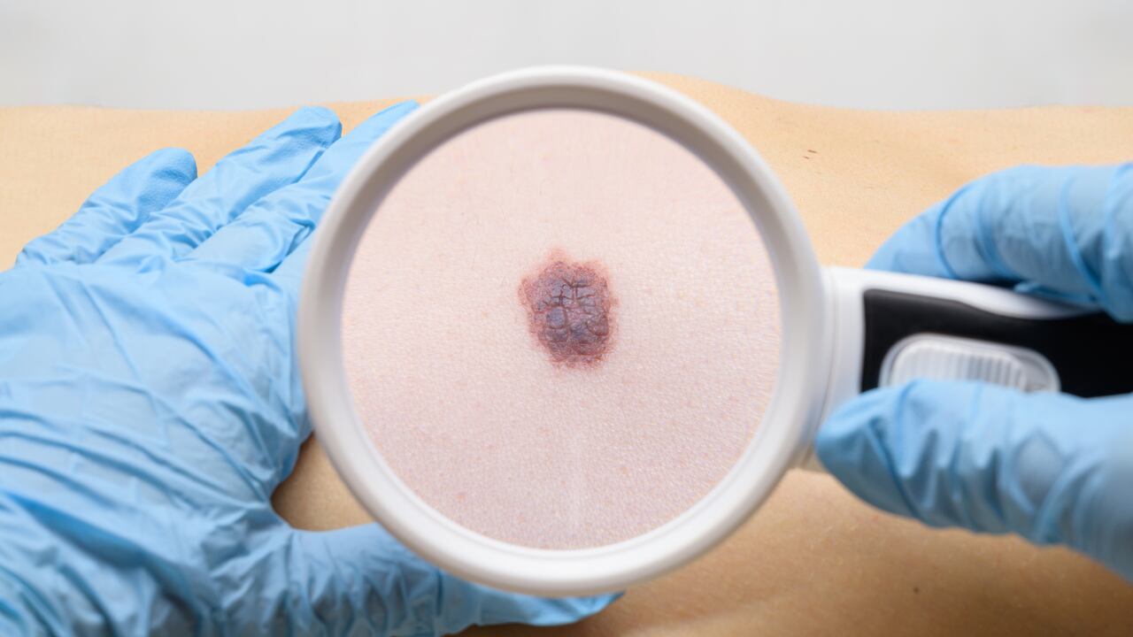 Examen del melanoma
