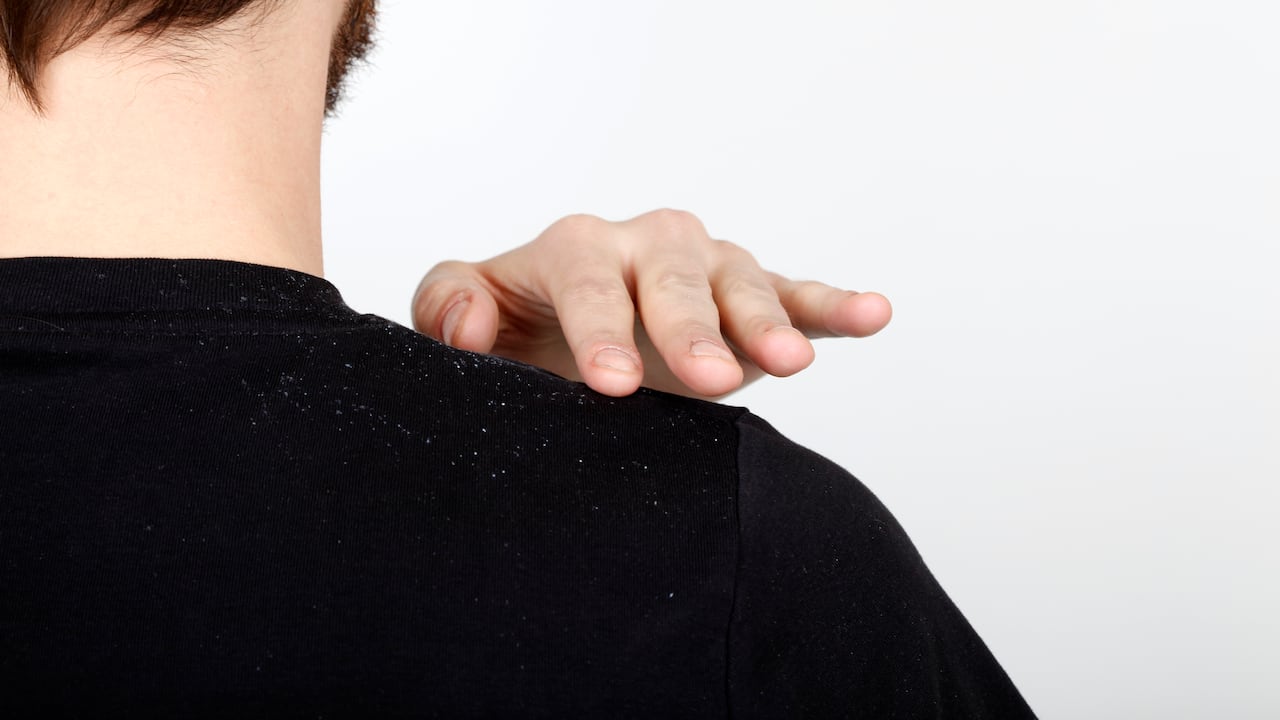 Entre las causas de la caspa se encuentran la piel seca, irritada o grasosa, sensibilidad a los productos para el cuidado del cabello.