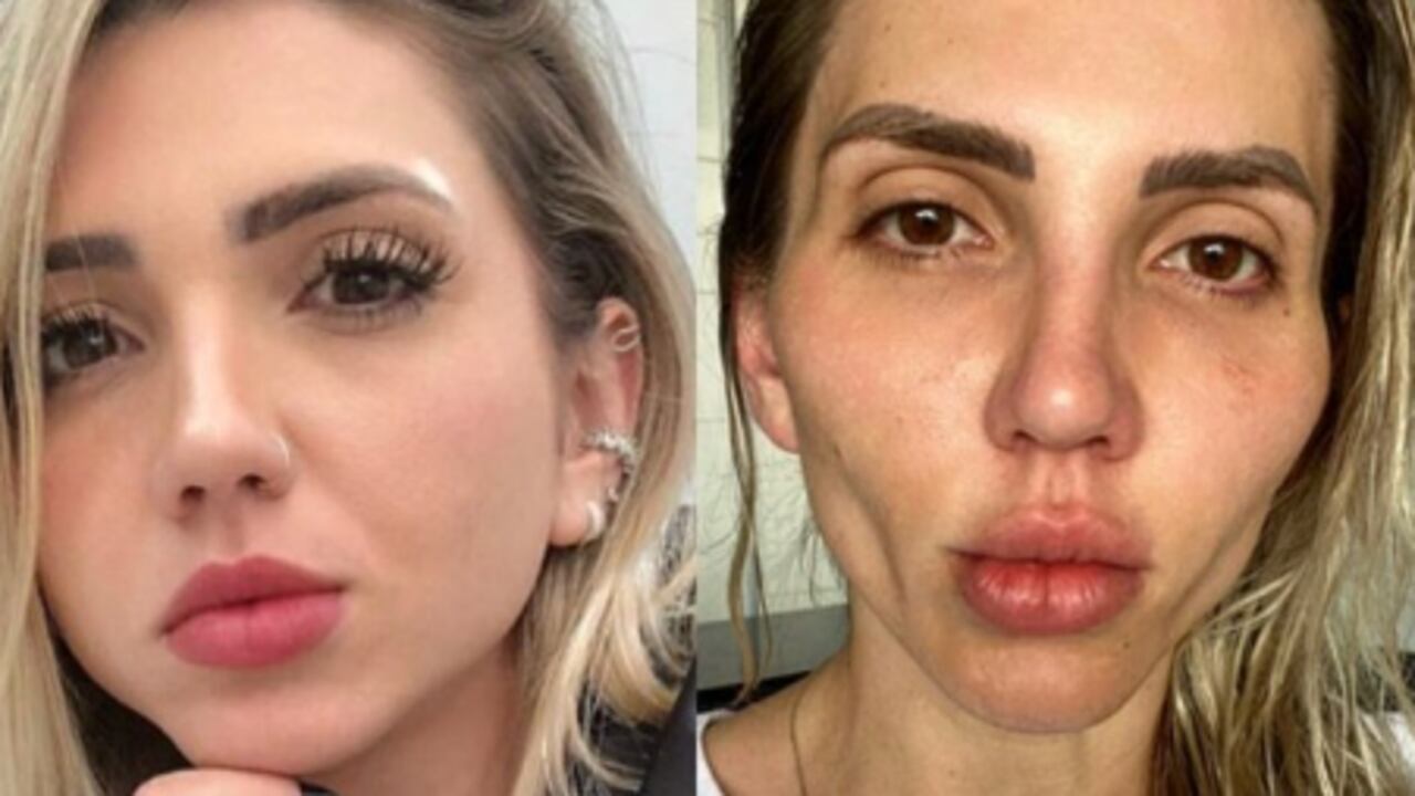 Como una "calavera" quedo hermosa mujer tras someterse a cirugía en el rostro