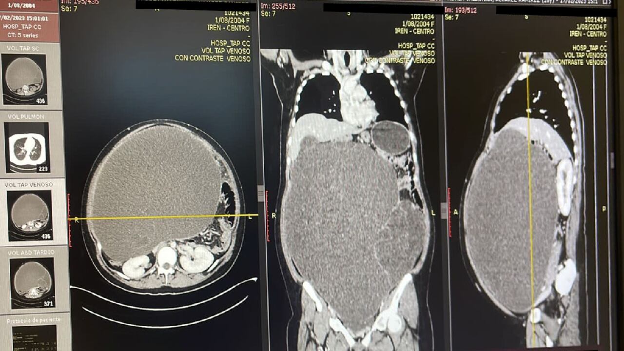 Foto de la radiografía del impresionante tumor que tenía la mujer en el abdomen.