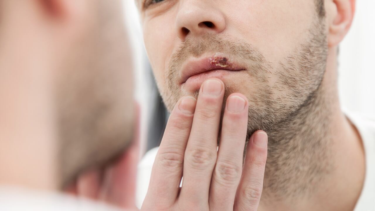 ¿Cómo puedo tener sexo con un herpes genital?
