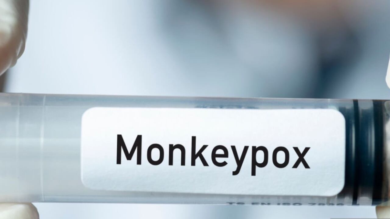 La viruela del mono está siendo detectada en varios países del mundo