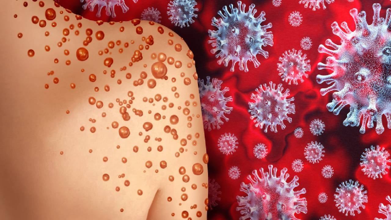 La OMS asegura que la viruela del mono no tiene la misma incidencia mundial que tuvo la covid-19, pero advierte que es importante mantenerla en el radar para evitar graves consecuencias. Foto: Getty images.